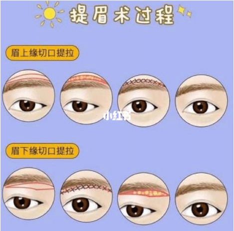 切眉手術(shù)的原理是什么？切眉手術(shù)能解決什么問(wèn)題?