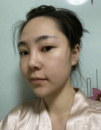 南京康美整形醫(yī)院靠譜不！馮思陽隆鼻案例效果及價(jià)格一覽！