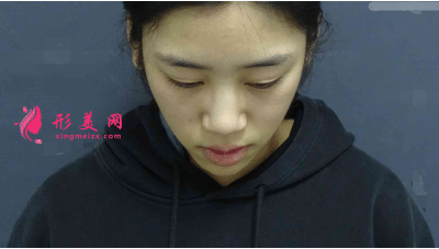 重慶星榮整形外科醫(yī)院隆鼻怎么樣？附隆鼻案例及2022價格表一覽