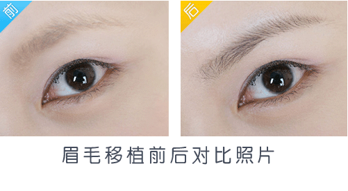 眉毛的價(jià)格一般是多少?種植眉毛可以維持多長(zhǎng)時(shí)間