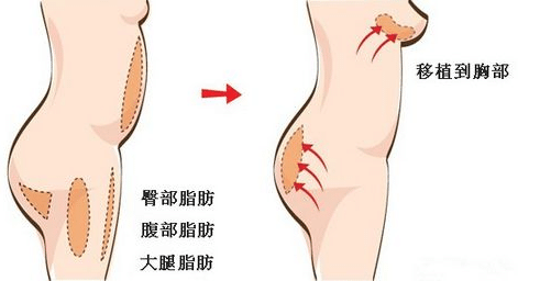 自體脂肪隆胸好不好？