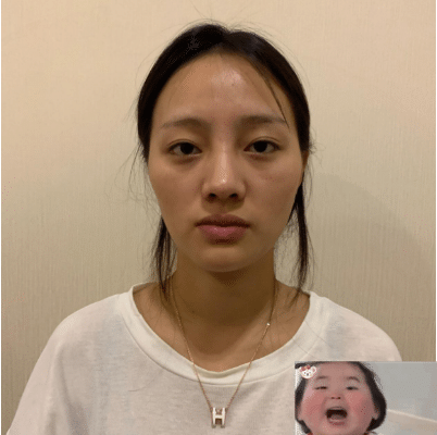 北京新星靚做面部脂肪填充效果好不好？