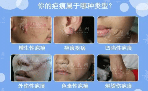 四川友誼醫(yī)院整形科祛疤技術(shù)怎么樣？銀偉男、李萍_價格點評