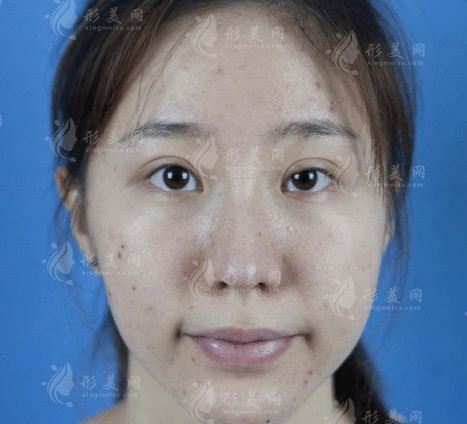 武漢五洲整形美容醫(yī)院面部提升價(jià)格貴嗎？收費(fèi)表及案例公布