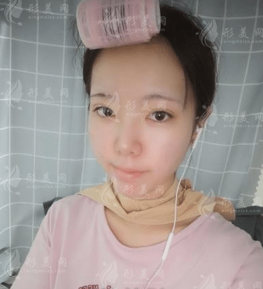 上海九院韋敏磨骨怎么樣？顴骨下頜角價(jià)格表|手術(shù)案例鑒賞