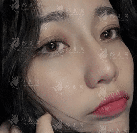 上海九院祝聯(lián)隆鼻多少錢？全新收費標準及案例一覽