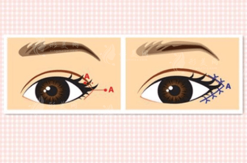 開外眼角會(huì)不會(huì)有疤痕？這些“毀眼習(xí)慣”你中招了嗎？