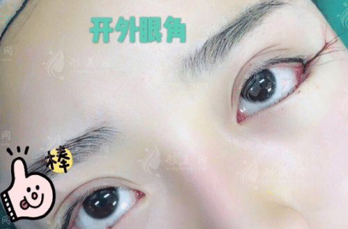 開外眼角會(huì)不會(huì)有疤痕?