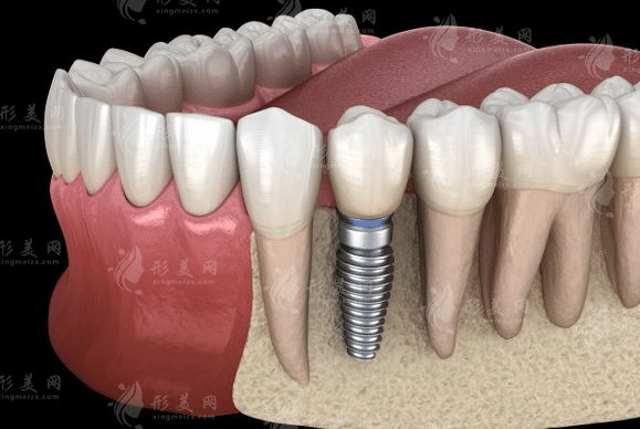 種一顆牙大概需要多少錢2023，國(guó)產(chǎn)進(jìn)口種植體收費(fèi)價(jià)格