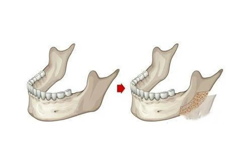 上海華美醫(yī)療美容整形醫(yī)院磨骨價(jià)格，收費(fèi)價(jià)格表/醫(yī)生介紹