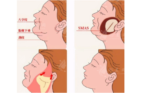 北京聯(lián)合麗格楊大平哪項手術(shù)更專業(yè)?