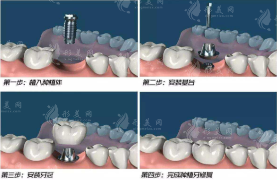 在北京種一顆牙大概需要多少錢？