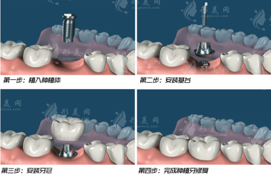 種植牙多少錢(qián)一顆2023年價(jià)格表更新出爐！