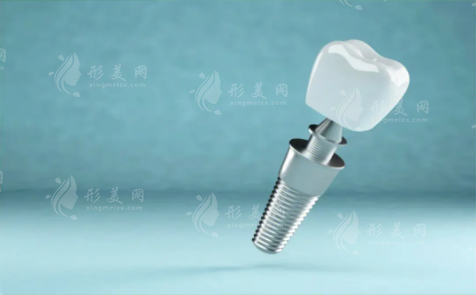 種植牙多少錢(qián)一顆