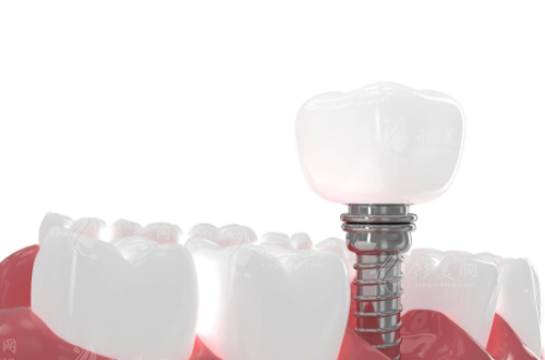 種植牙的原理是什么呢?