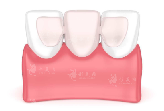 美容冠矯正牙齒的步驟如何？初步評估和診斷、維護(hù)和保養(yǎng)…