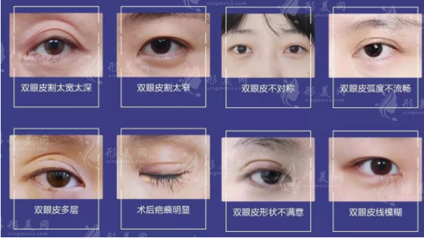 雙眼皮手術(shù)類型有哪些？割雙眼皮術(shù)、點(diǎn)切雙眼皮術(shù)…