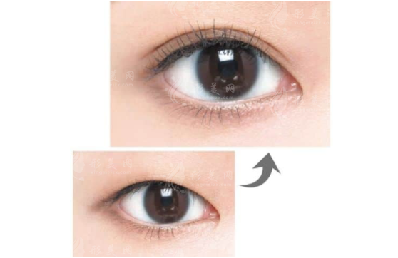 雙眼皮手術(shù)類型有哪些？割雙眼皮術(shù)、點(diǎn)切雙眼皮術(shù)…
