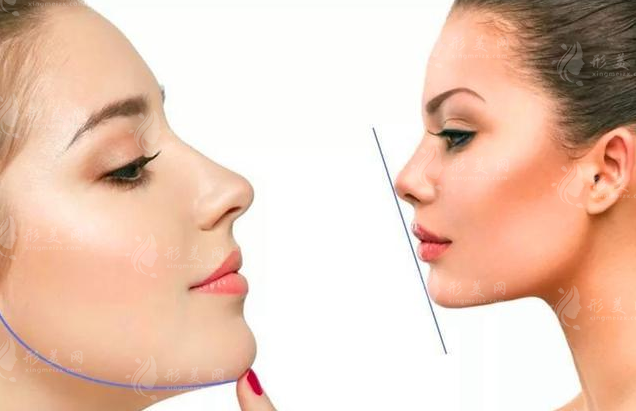 下巴上翹怎么矯正圖片，三種常見(jiàn)方式為你解答