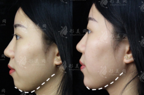 下巴上翹怎么矯正圖片，三種常見(jiàn)方式為你解答