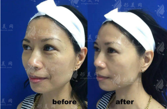 眼部除皺的最好方式和價格，看看除皺哪種效果更好？