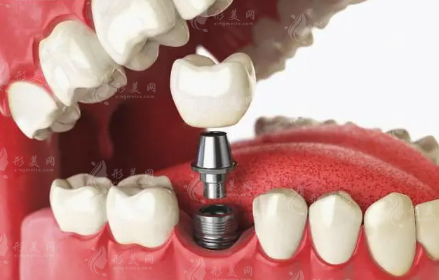 以色列種植牙多少錢一顆?