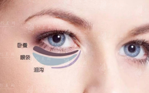 自體脂肪豐臥蠶容易移位嗎？可以采取哪些措施？