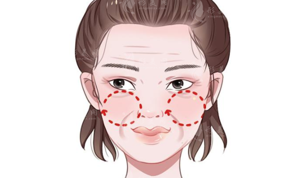 真性法令紋和假性法令紋的區(qū)別有哪些？