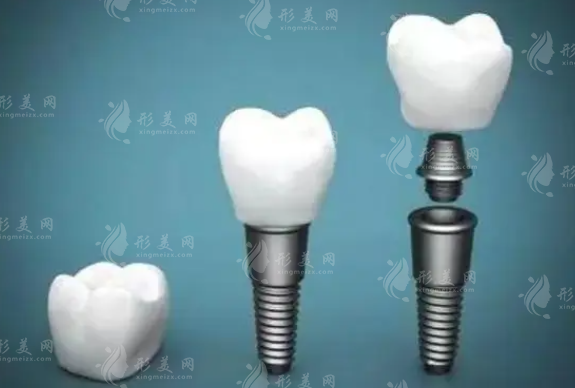 種植牙多少錢一顆2023價(jià)格表，單顆/半口/全口植牙費(fèi)用！
