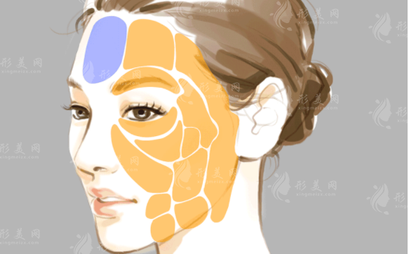 自體脂肪填充可以消除面部皺紋嗎？效果如何？