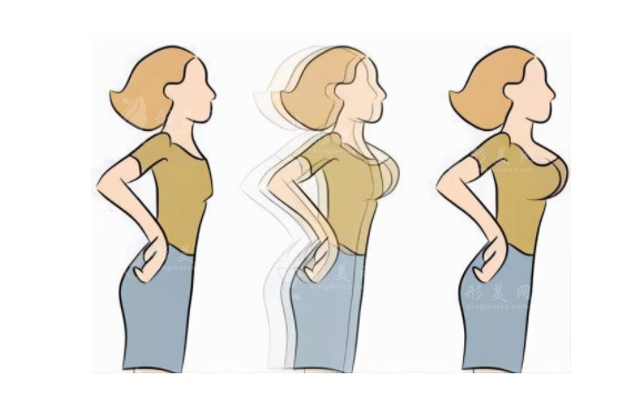 假體豐胸效果生硬怎么辦？手術(shù)前后注意事項(xiàng)有哪些？