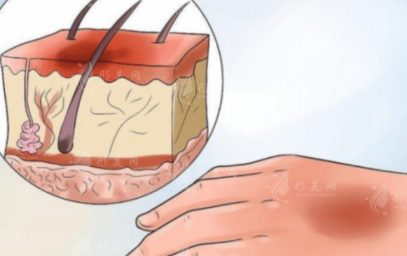 激光疤痕修復(fù)收費(fèi)價(jià)格高嗎？術(shù)后注意事項(xiàng)有哪些？