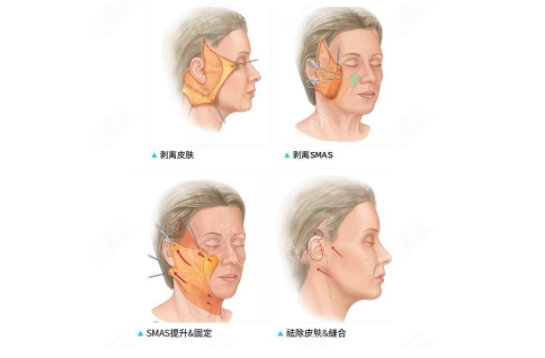 面部年輕化手術(shù)