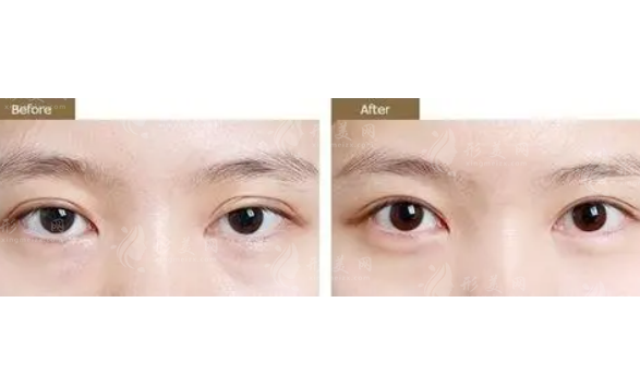 雙眼皮修復(fù)的方案有幾種？恢復(fù)期長嗎？難度大不大？