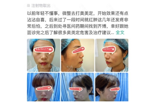 廣州荔灣區(qū)人民醫(yī)院異物取出怎么樣？