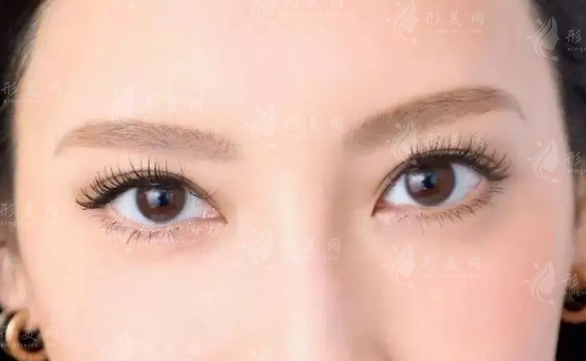 哪些情況下需要做雙眼皮修復(fù)？雙眼皮過寬怎么辦呢？