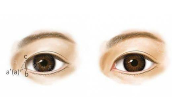 內(nèi)眥贅皮一定要開(kāi)眼角嗎？收費(fèi)價(jià)格貴嗎？