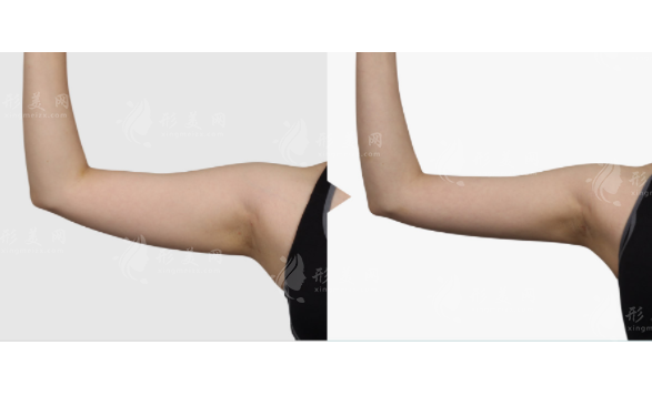 你了解過手臂吸脂嗎？哪些人適合做手臂吸脂手術(shù)？