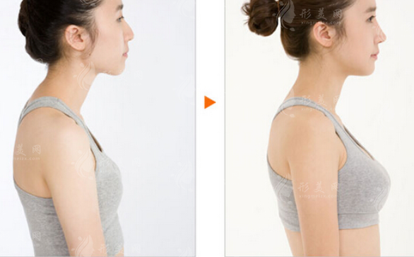 內(nèi)窺鏡雙平面隆乳術(shù)技術(shù)要點都有哪些呢？