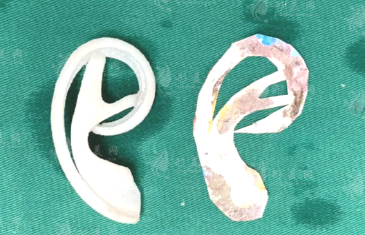 鄭大二附院李鋼醫(yī)生的全耳再造