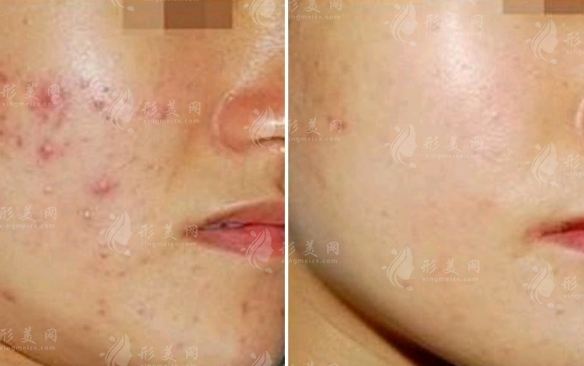 紅藍(lán)光祛痘多久做一次？可以根治嗎？