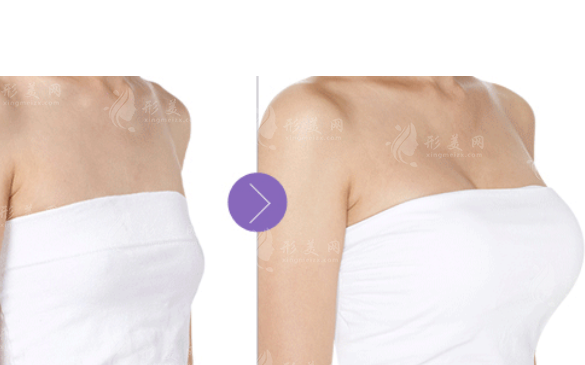 自體脂肪豐胸手術(shù)費(fèi)大概要多少錢？副作用和危害有哪些？