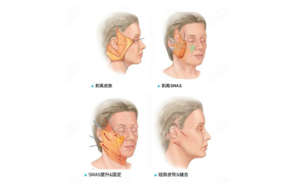 上海排名前十醫(yī)院拉皮手術(shù)價格一覽表