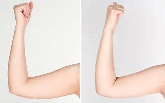 水動(dòng)力吸脂一般需要多少錢？手術(shù)效果有保障嗎？