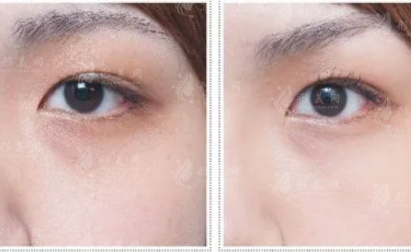 光子去黑眼圈多少錢(qián)？項(xiàng)目對(duì)眼睛有害嗎？