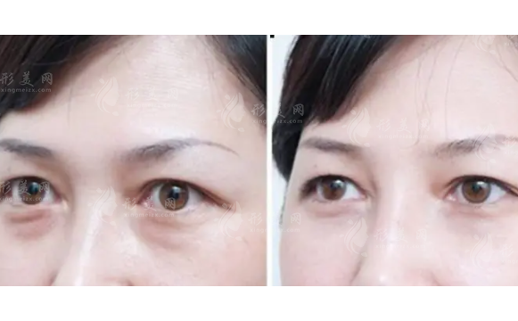 超聲波去眼袋一般多少錢？效果能維持多久？