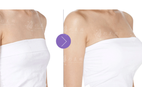 假體隆胸or自體脂肪隆胸，究竟應(yīng)該怎么選？