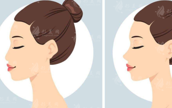 廣州曙光做鼻子多少錢？好評醫(yī)生簡介、案例分享、收費表新鮮出爐！