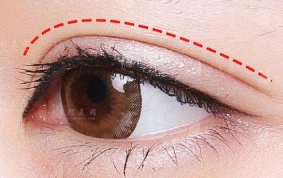 埋線雙眼皮需要拆線嗎?術(shù)后多久能恢復(fù)~ 埋線雙眼皮需要拆線嗎?術(shù)后多久能恢復(fù)~