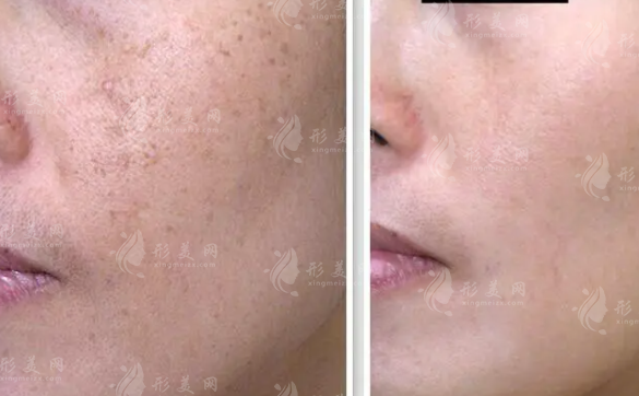 激光祛黃褐斑會反彈嗎?術后護理要注意~